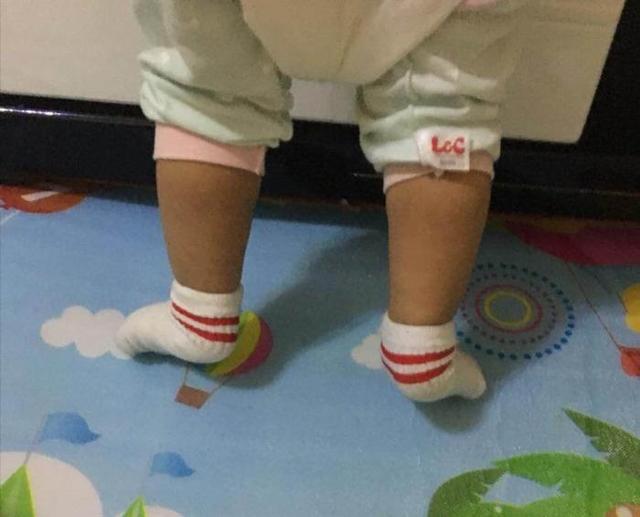 「你的育儿经」2岁宝宝因鞋不合适，造成“足外翻”，这几种鞋子别再给孩子买了