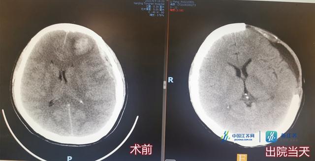 患者|脑出血病人死里逃生，送锦旗感谢救命之恩