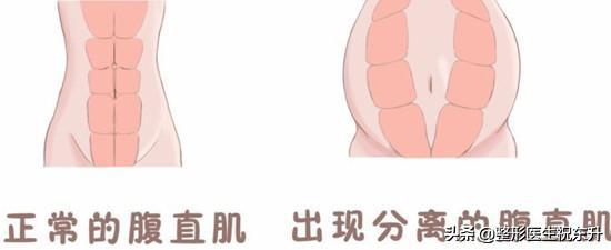 【超级宝妈】产后肚皮松弛、小肚子严重? "平坦小腹赘肉"试试这样做