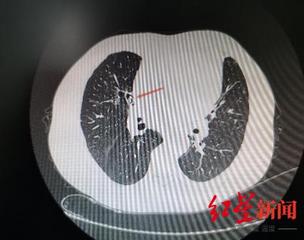 异物|男子近几年肺部反复感染入院，原因竟是“藏身”肺叶10年的一块鸡骨头