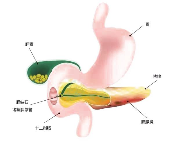 怎么就得了胰腺炎了？谈谈一种能引起胰腺炎的疾病IPMN