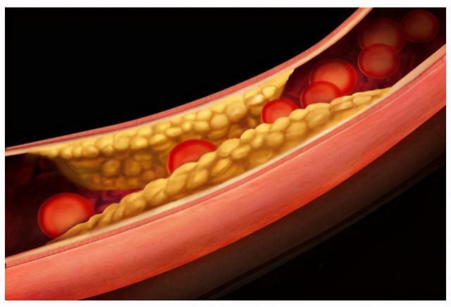 什么药物是血管内油脂的“清道夫”？