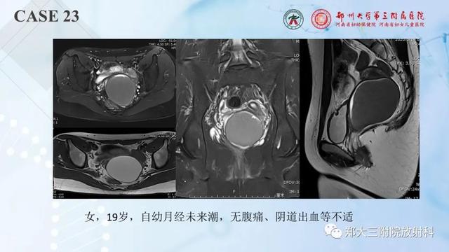 儿童腹部囊性病变诊断思路分析