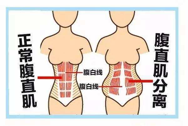 你的育儿经|腹直肌分离四指，五个月穿回S号裤子：二胎妈妈居家修复技巧