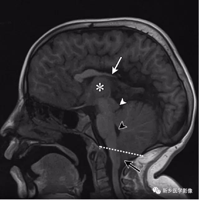 大脑中线处常见的25种疾病