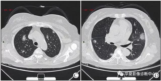 「影像进展」新冠肺炎的CT典型和不典型表现以及影像学分期