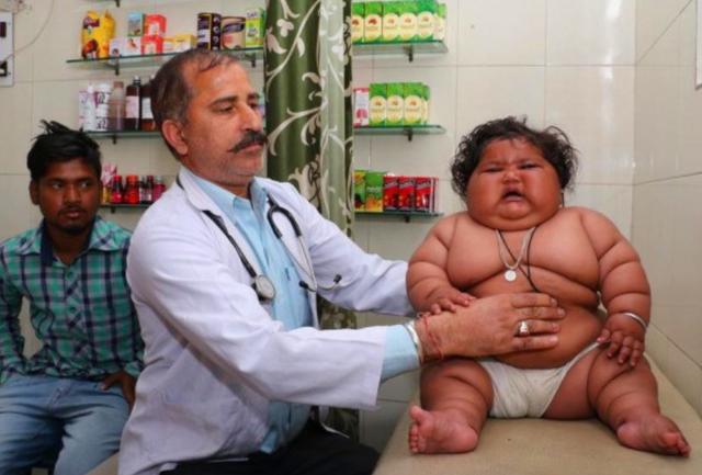 [超级宝妈]1岁体重就高达45斤的“米其林宝宝”，如今啥样了？不出人们所料