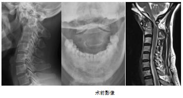 寰枢椎|莆田：这项新技术让&amp;#34;手术禁区&amp;#34;变&amp;#34;通途&amp;#34;