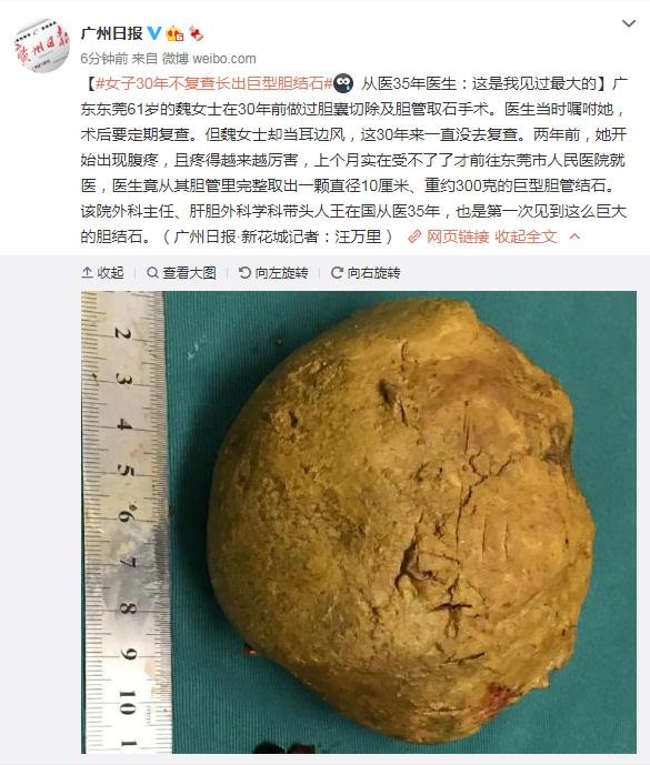 复查|女子30年不复查长出巨型胆结石 从医35年医生：这是我见过最大的