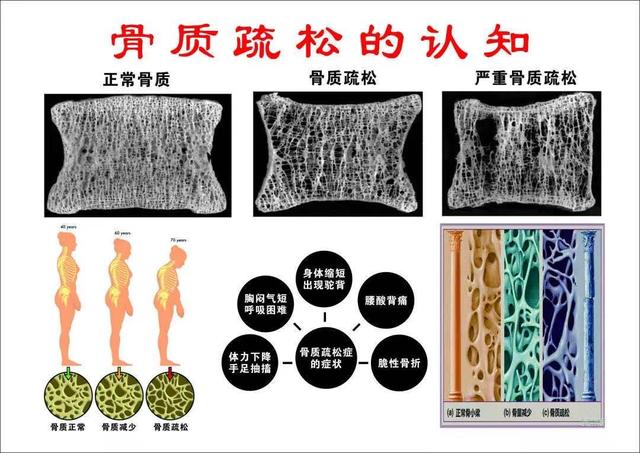 警惕骨质疏松，骨密度筛查很重要