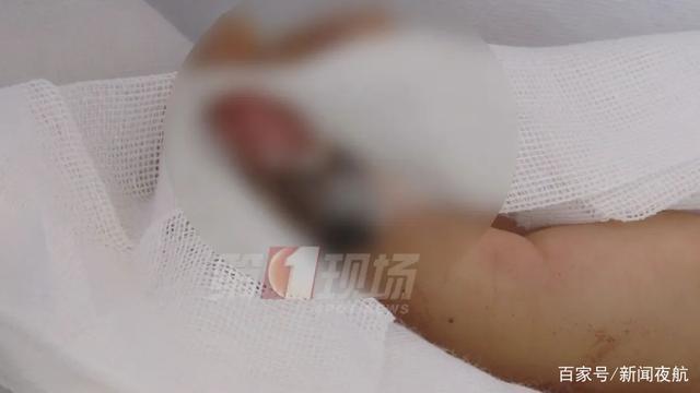 婉转应和|4岁女童手指被夹断！家中这个细节务必注意