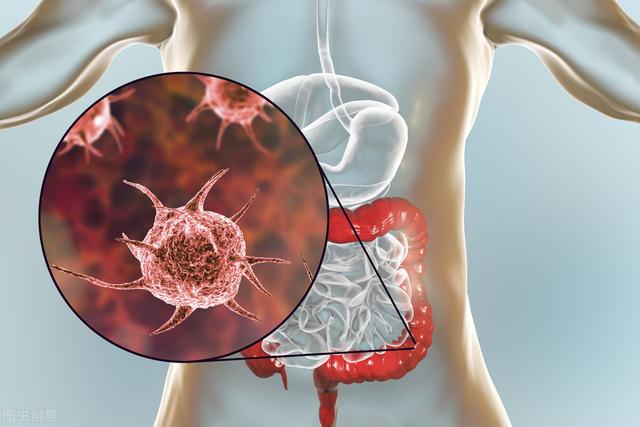 体内有癌，大便先知？大便若出现5个早期信号，当心结肠癌的到来