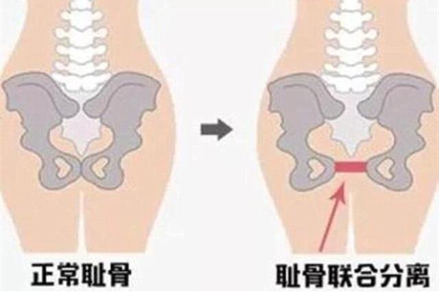 超级宝妈|有种疼痛叫“耻骨痛”,这5种孕妇还会“疼痛加倍”,孕妈要注意