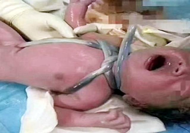 [你的育儿经]孕期这些行为，导致胎儿被“捆绑”，宝宝出生后的模样让人心疼