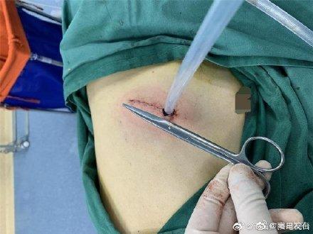 单孔|单孔新纪元！江西完成首例单孔机器人肺癌根治术