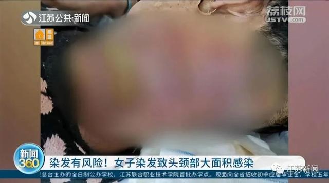 女士|染发有风险！女子染发致头颈部大面积感染
