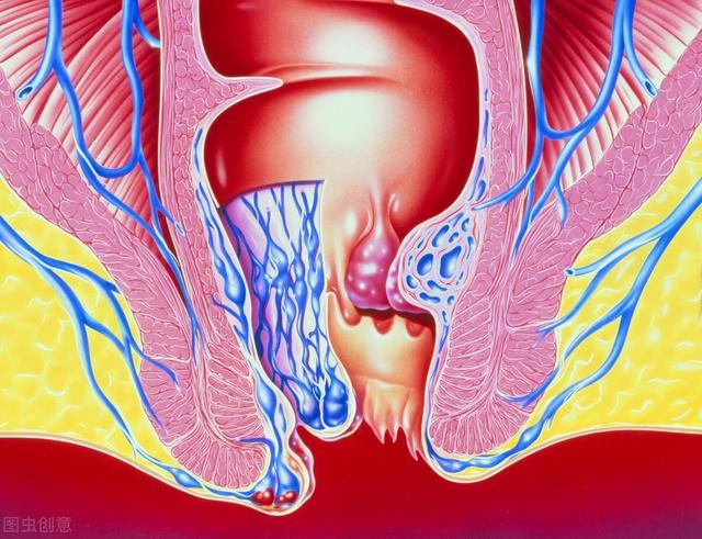 痔疮久治不愈，会发展成肠癌吗？如何区分痔疮还是肠癌？来看此文