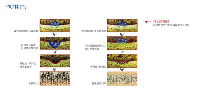 困扰中老年女性的绝经后骨质疏松，有何症状？试试这4个方法缓解