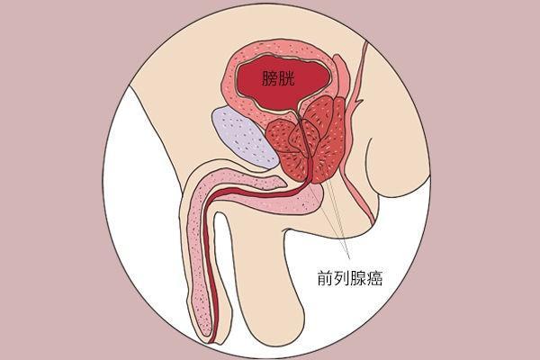 前列腺癌是怎么来的？4个诱发因素，为了健康，男性该早点避开