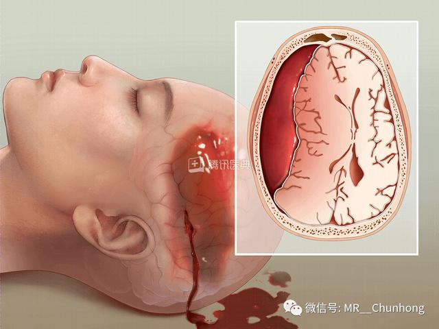 硬膜外与硬膜下出血的血来自哪里