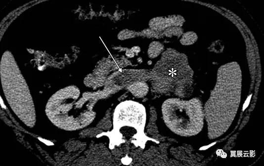 24张图汇总「肾血管」常见病变的影像学表现