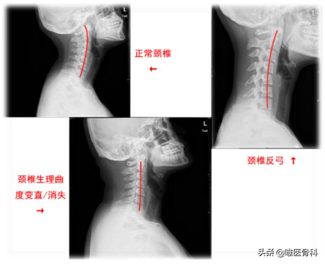 颈椎病的 3 种检查，两种治疗方法，医生想告诉你的小知识