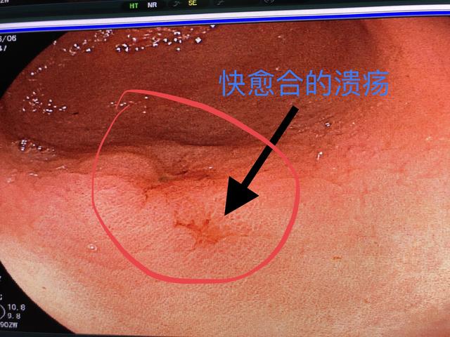 消化性溃疡|胃肠溃疡不吃药会自愈吗？