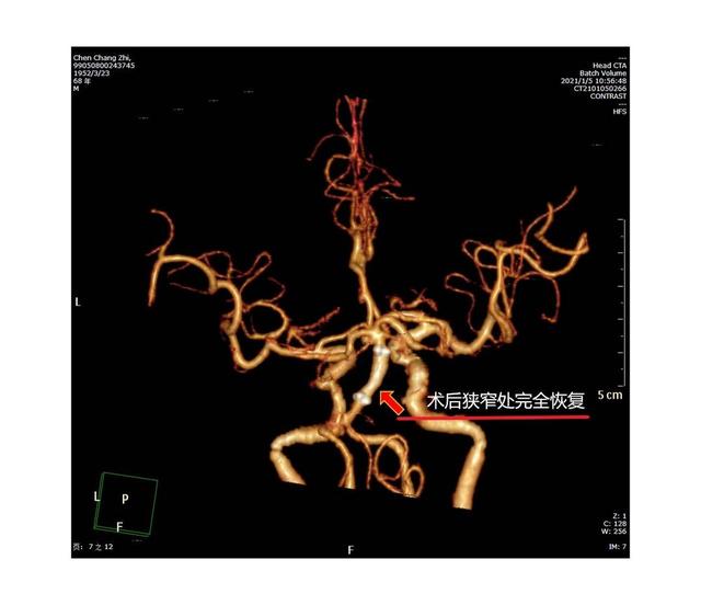 几十年烟酒不离身 69岁老人血管堵塞险丧命