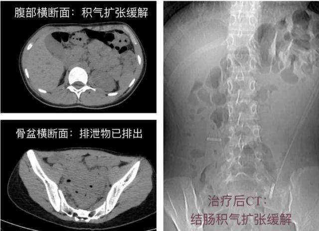 高中生女孩长期便秘，子宫竟被挤偏！治疗后，她一夜“轻了”8斤