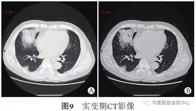 「影像进展」新冠肺炎的CT典型和不典型表现以及影像学分期