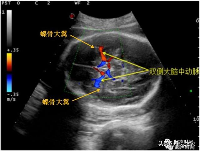 晴空蓝兮|胎儿大脑中动脉的测量和评估