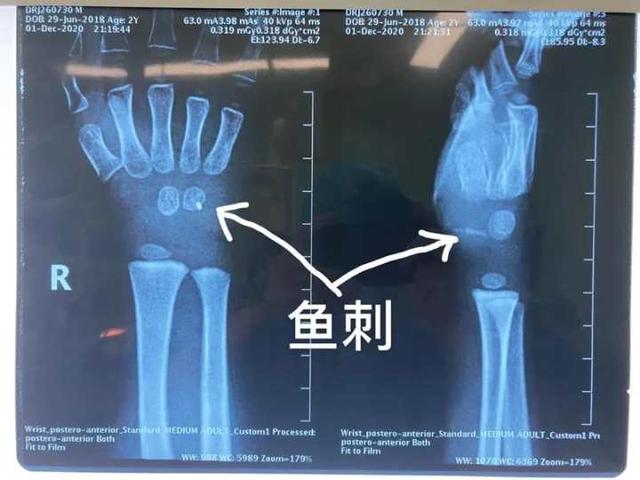 绞肉机、鱼刺都很危险，家长得看住熊孩子们的手