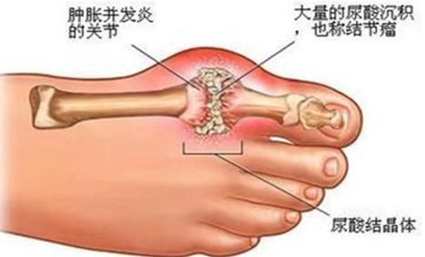 痛风|春节吃吃喝喝，当心TA来“拜年”