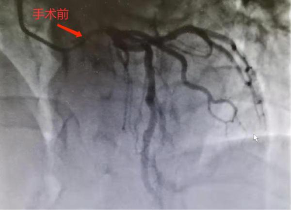 心肌|好险！浙江男子突然胸闷，检查指标都正常，结果差点没命