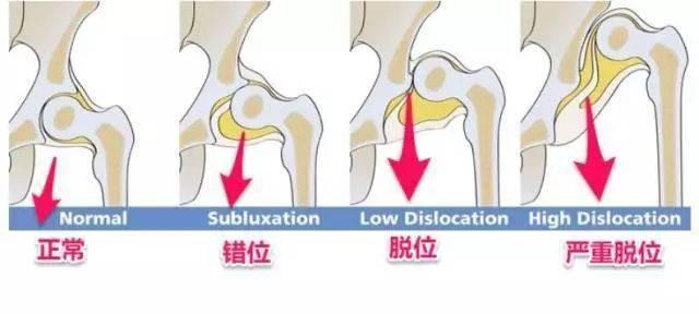 宝宝的臀纹不对称不仅“屁蛋丑”，还有发育隐患，错过难弥补