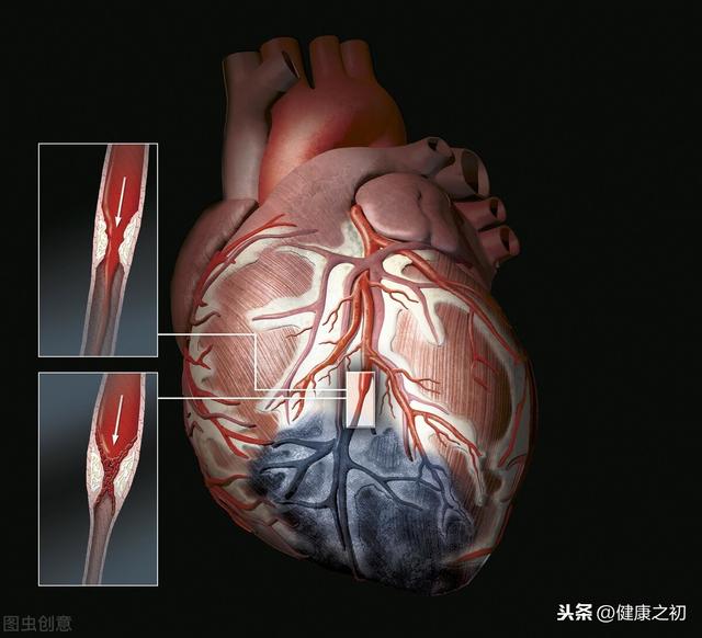 支架术后又搭桥，平稳度过30载，现89岁仍健朗，坚持了这2点