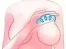 “乳腺增生”怕刮痧，多刮刮就好了