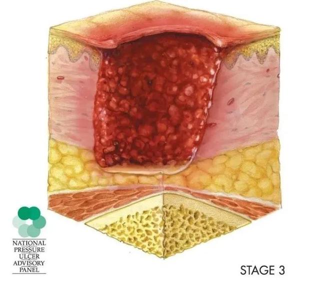 压疮情况要分期，严重危害需知道
