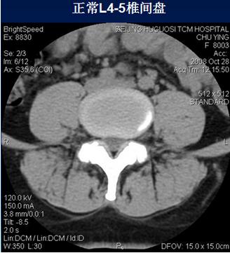 腰椎间盘CT诊断：椎间盘膨出、突出、椎管狭窄及退行性病变