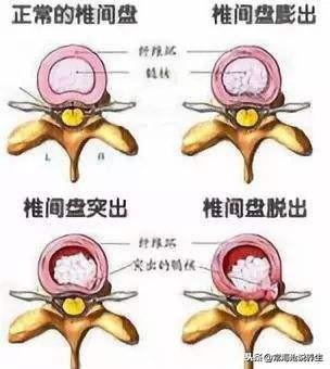 纤维环|还在被腰椎间盘疾病困扰？3种不同腰椎问题，别再傻傻分不清