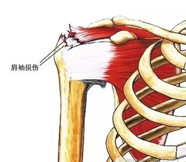 最常见的肩关节痛——肩袖损伤