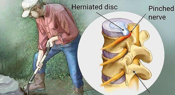 如果有腰间盘突出，仍然从事重体力劳动，会加重吗？医生告诉您