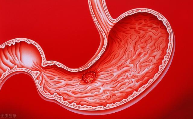 注意，胃溃疡恶化出现这6个症状需警惕，当心会发展成胃癌