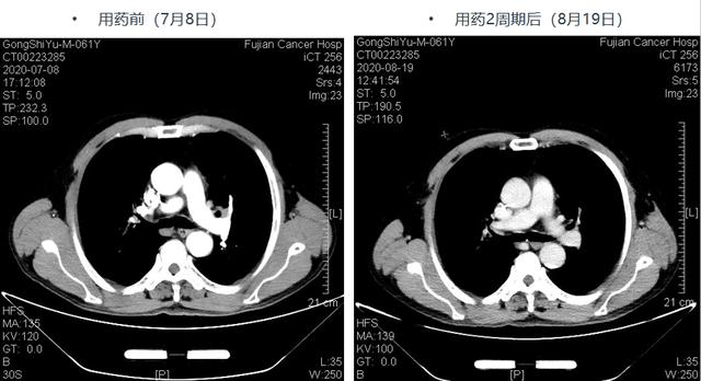 百例之约 | 新辅助免疫联合化疗为中晚期肺鳞癌患者带来惊喜！患者术后实现pCR