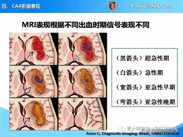 为什么对于脑出血的患者不建议做核磁，而要做CT呢？