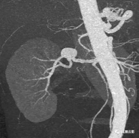 24张图汇总「肾血管」常见病变的影像学表现
