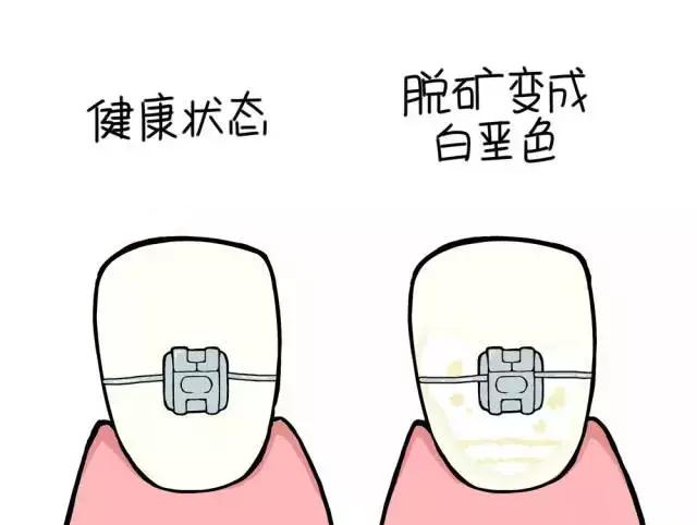 超级宝妈|孩子牙齿“变白”，家长却慌了！不重视这问题，好牙可能烂光
