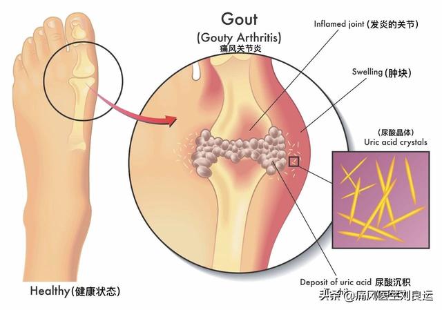 痛风患者喝苏打水能降尿酸治痛风？恐怕您弄错了碳酸氢钠的用处