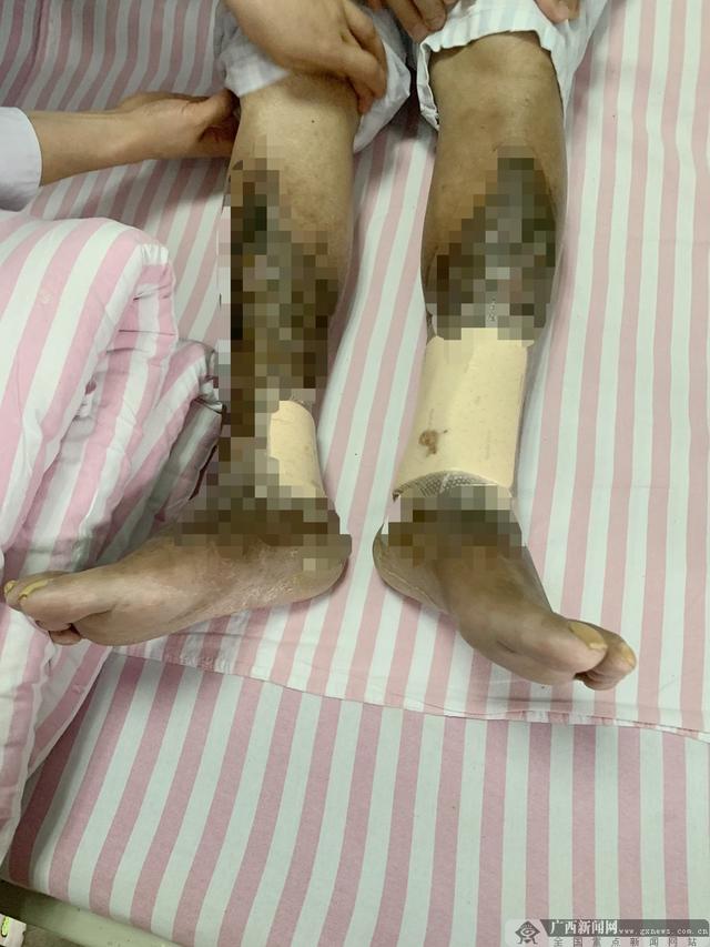 介入|二十多年“老烂腿”觅得良医 警惕被误诊的“布加综合征”