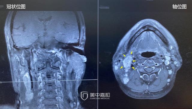 不再如履薄冰，这种治疗降低癌症复发率